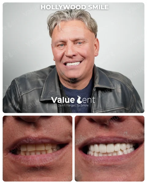 Hollywood Smile