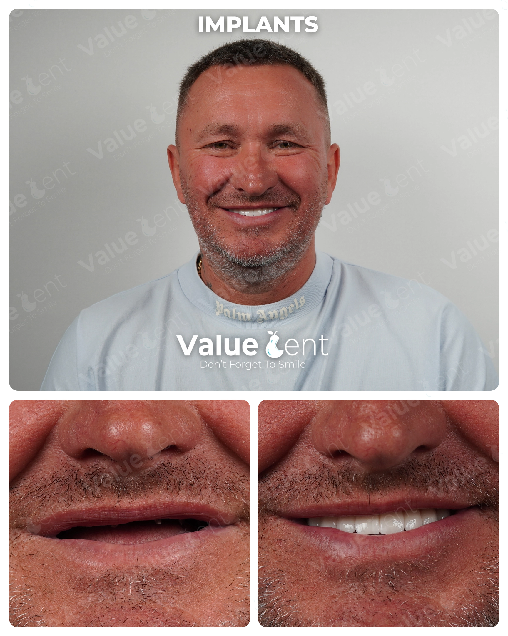 Full Mouth Implants Patient ValueDent