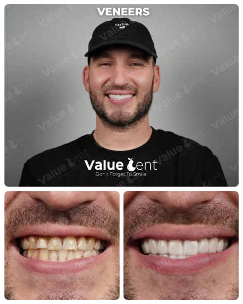 Veneers