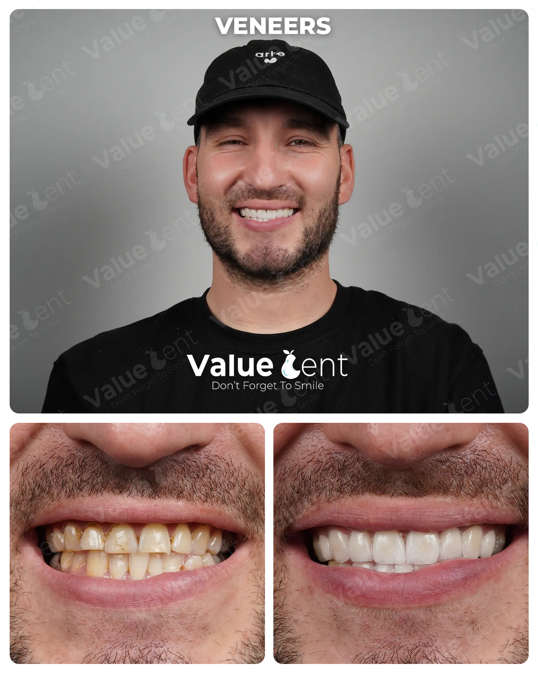 Veneers Patient ValueDent