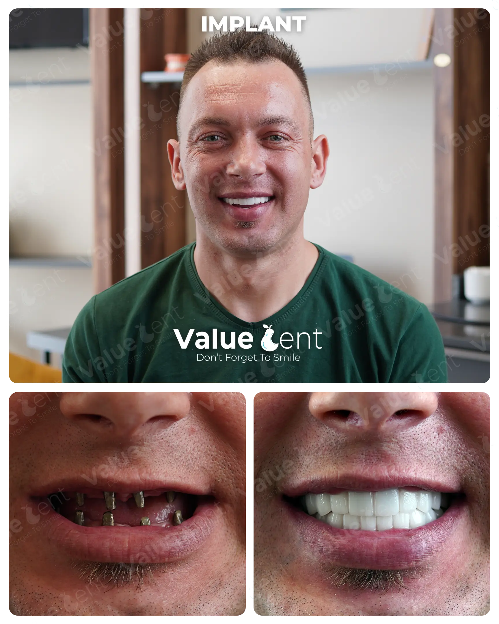 Full Mouth Implants Patient ValueDent