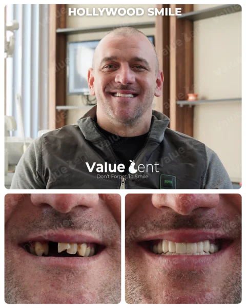 Hollywood Smile