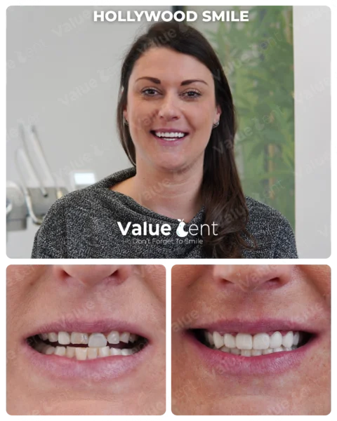 Hollywood Smile