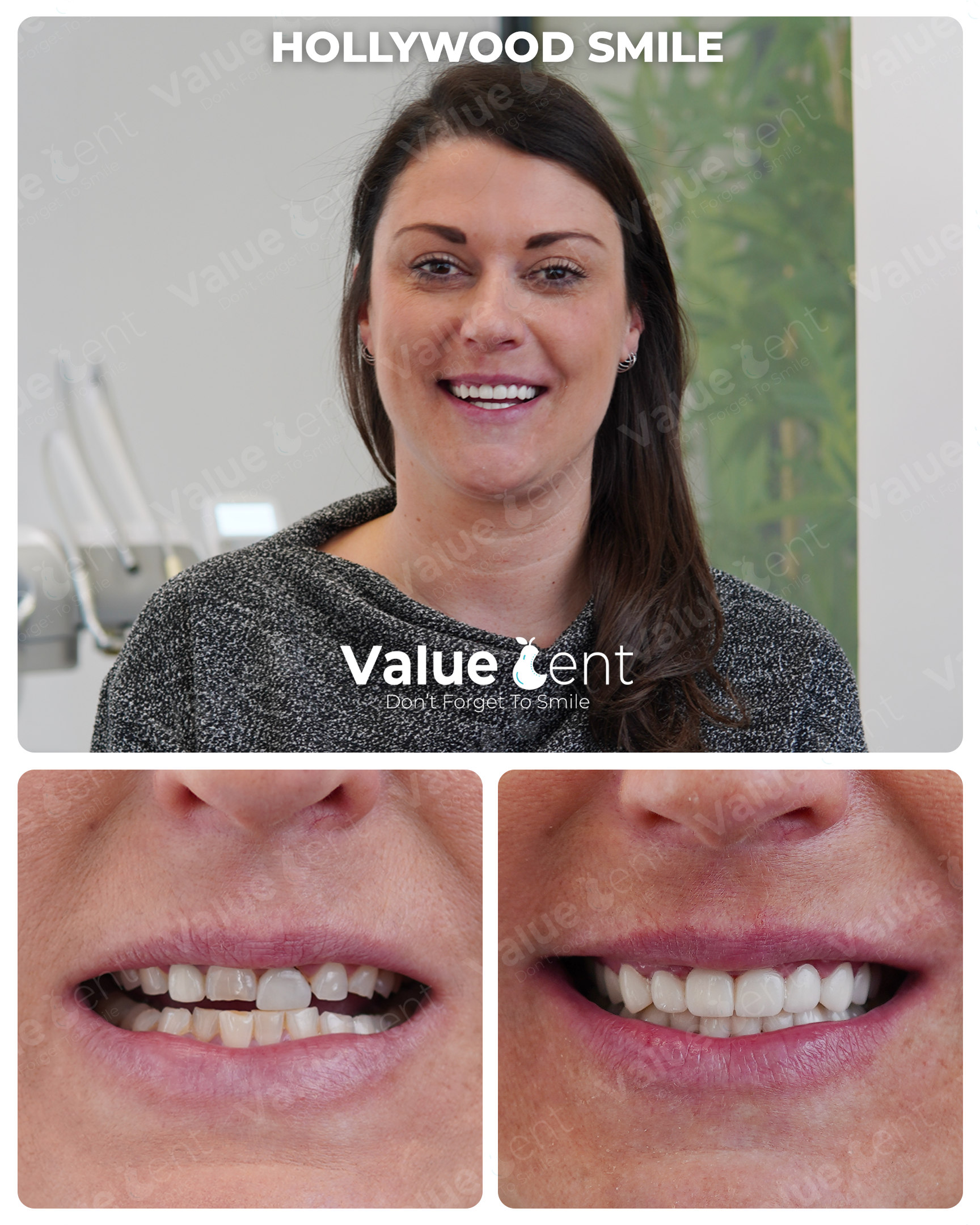 Hollywood Smile Patient ValueDent