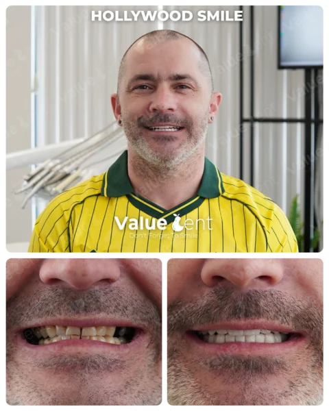 Hollywood Smile