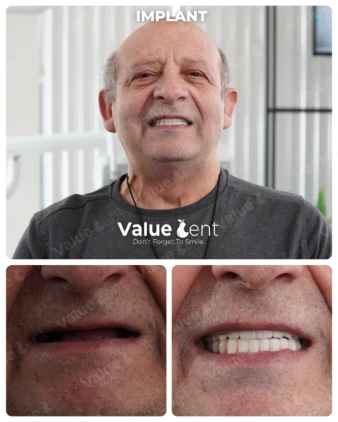 Implants
