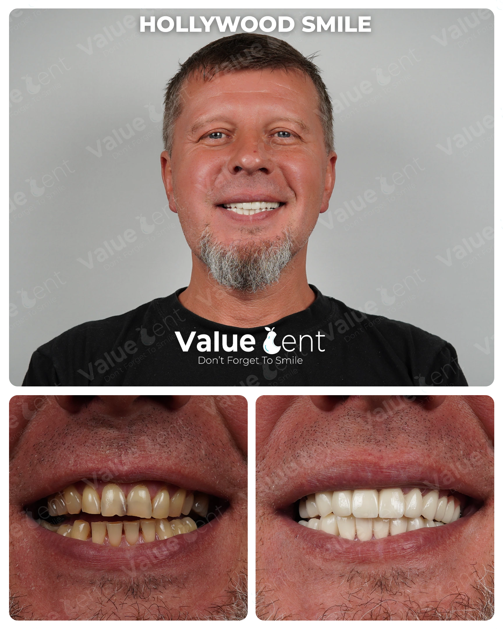 Hollywood Smile Patient ValueDent