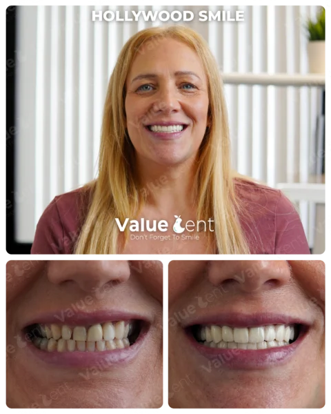 Hollywood Smile