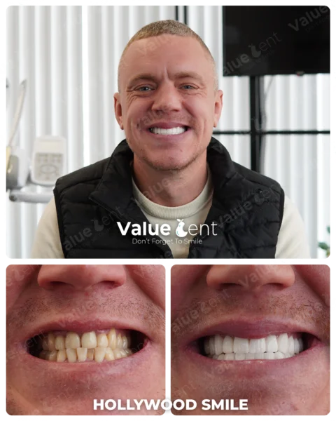 Hollywood Smile