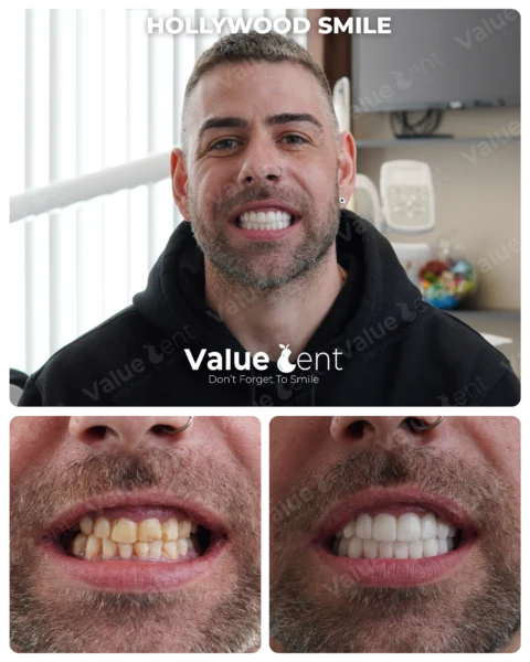 Hollywood Smile