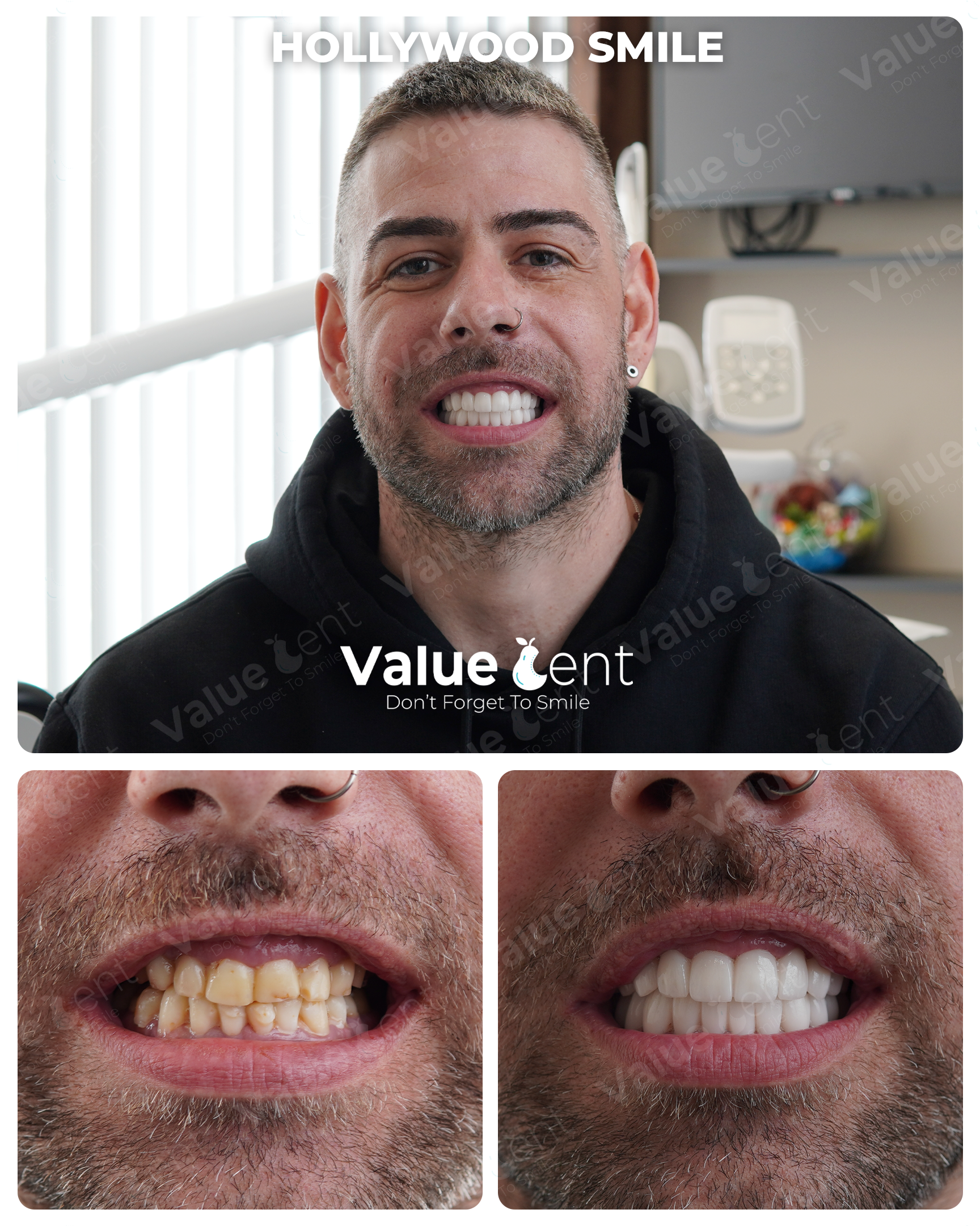 Hollywood Smile Patient ValueDent