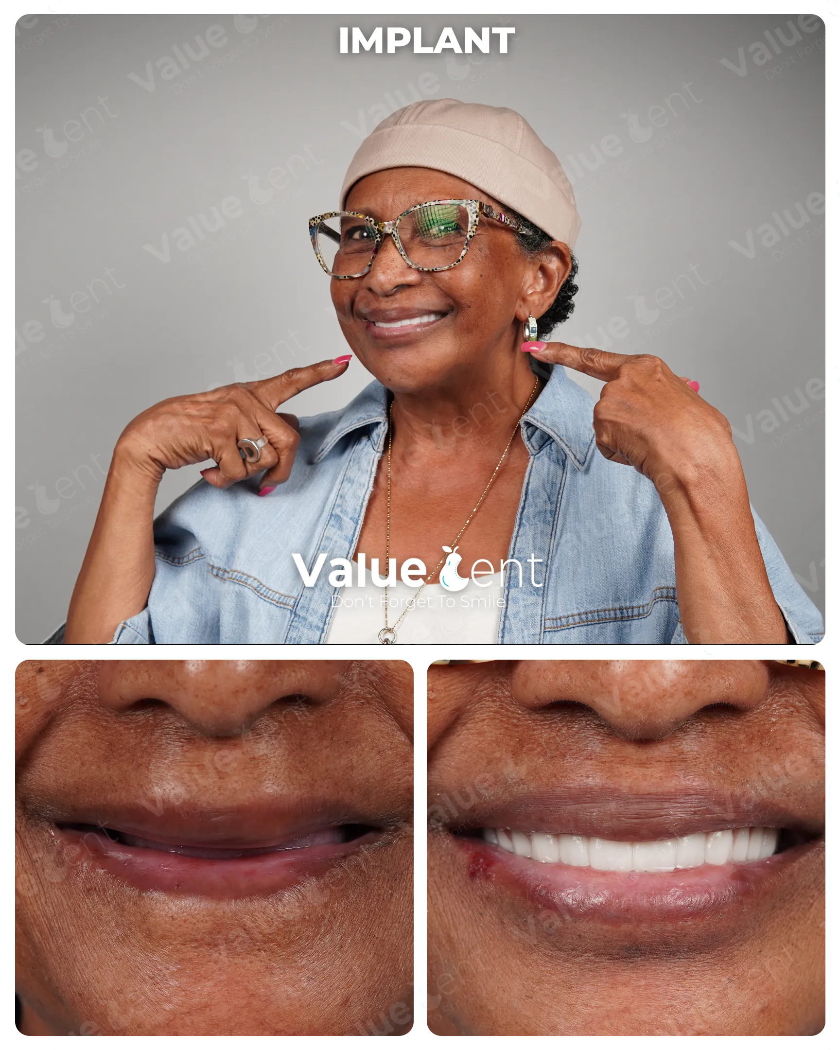 Full Mouth Implants in Istanbul Turkey at ValueDent Clinic