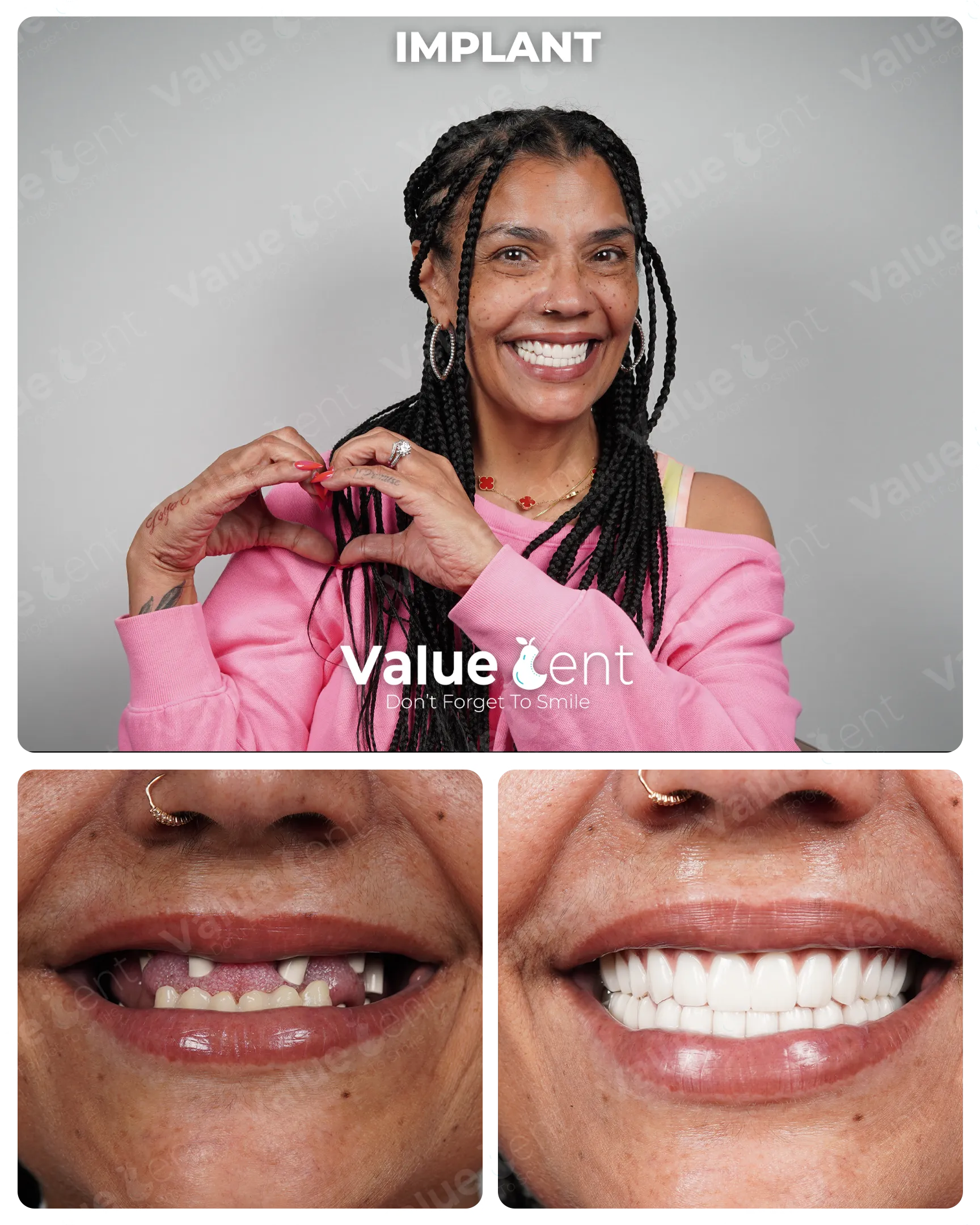 Full Mouth Implants in Istanbul Turkey at ValueDent Clinic