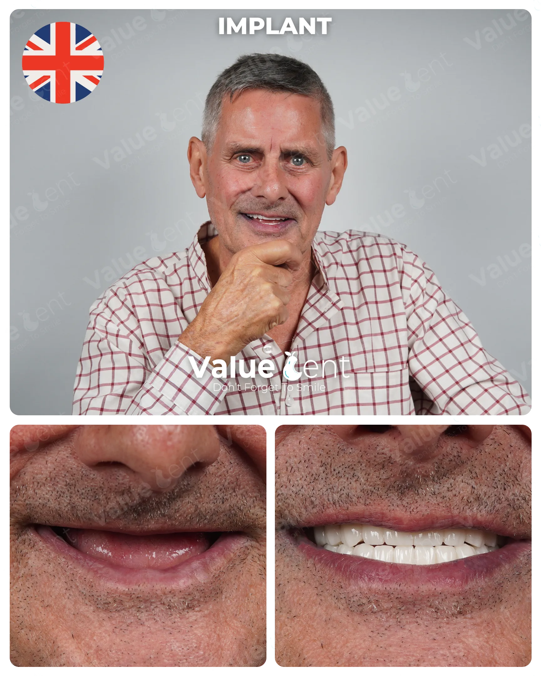 Full Mouth Implants in Istanbul Turkey at ValueDent Clinic