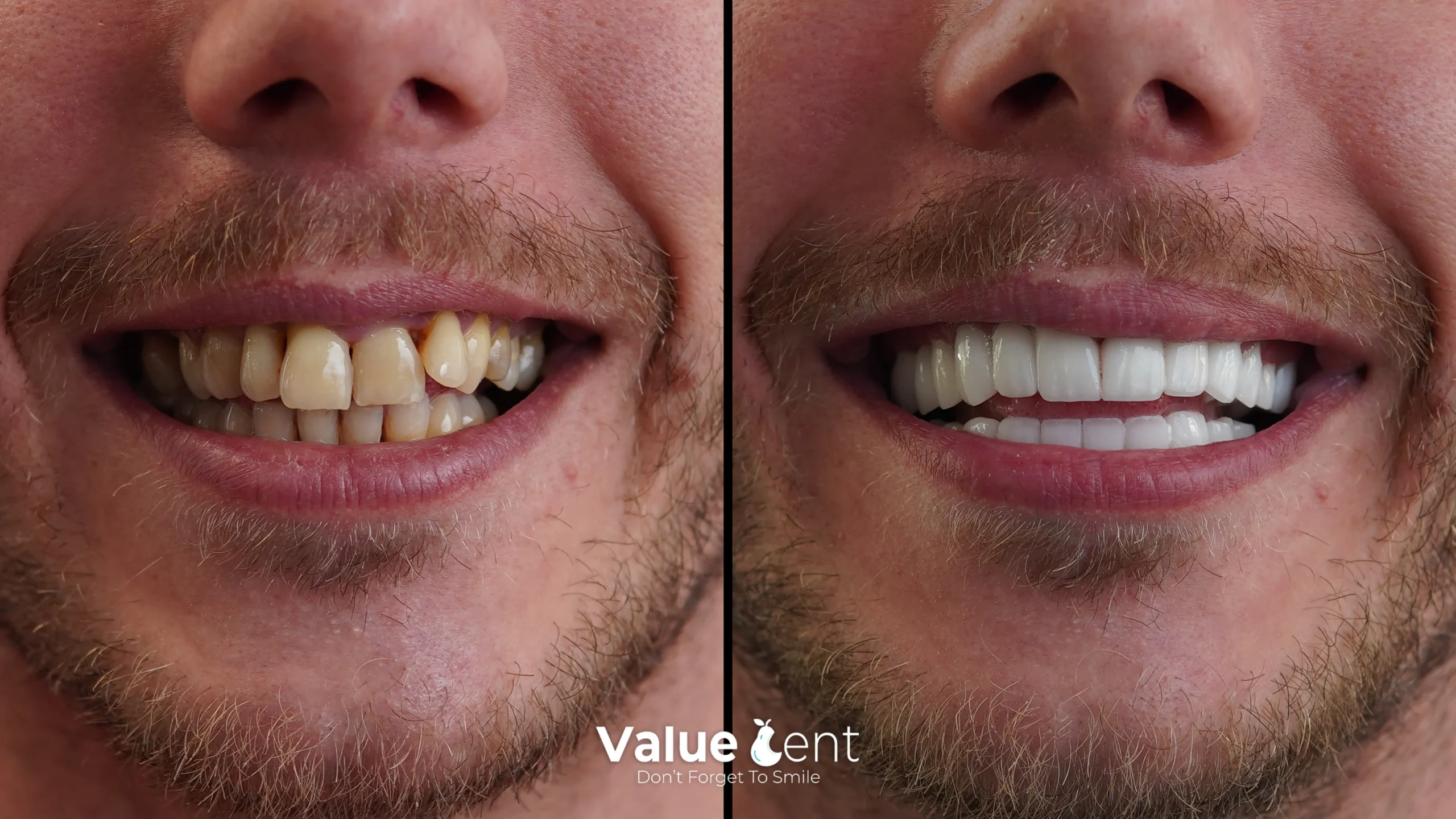 Hollywood Smile