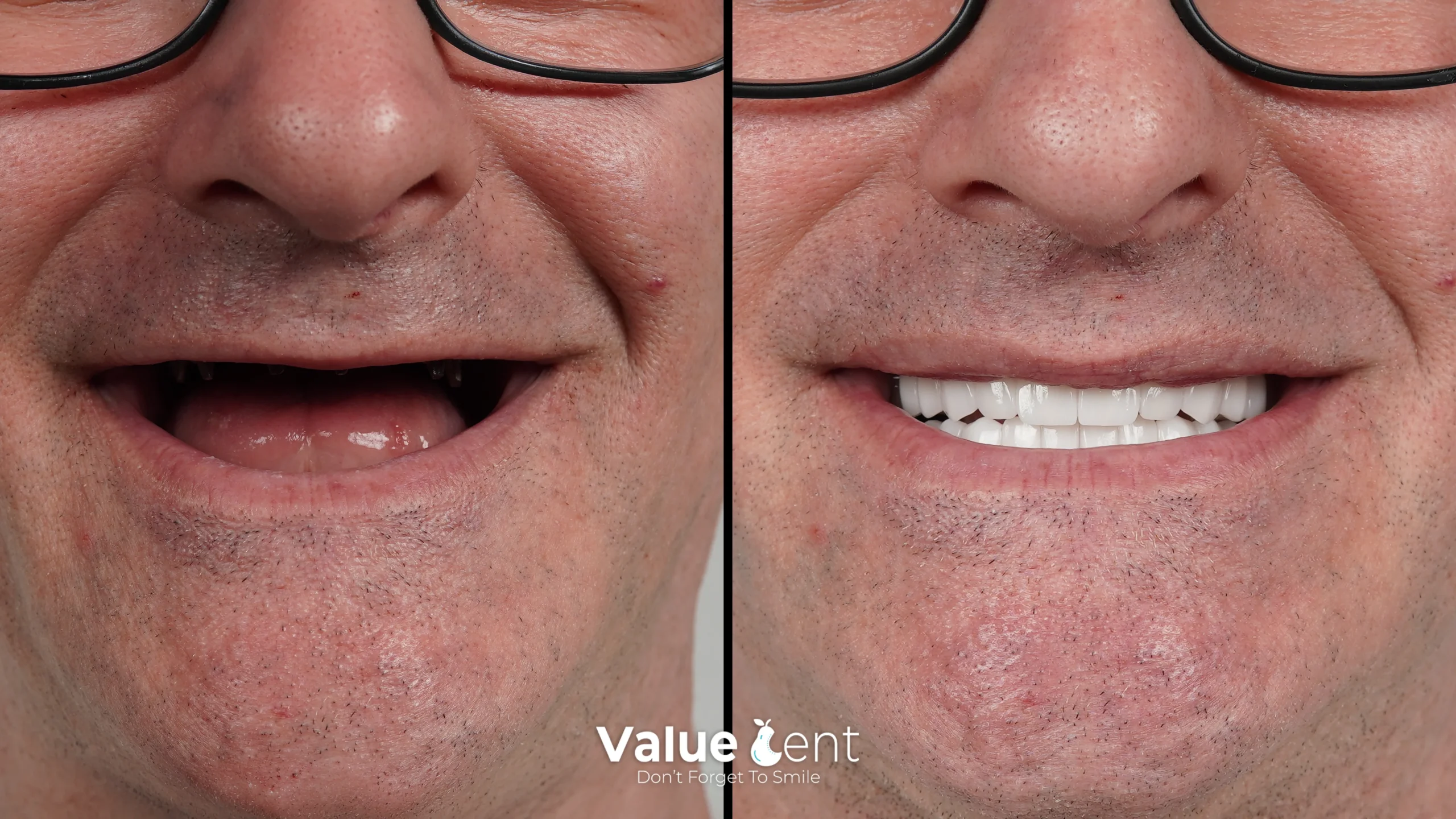 Dental Implants