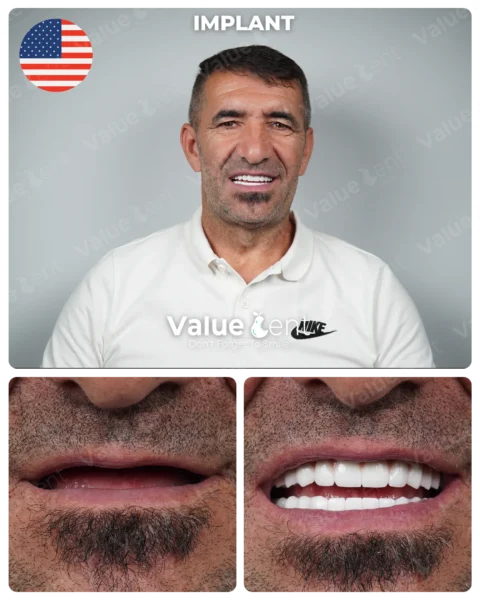 Implants