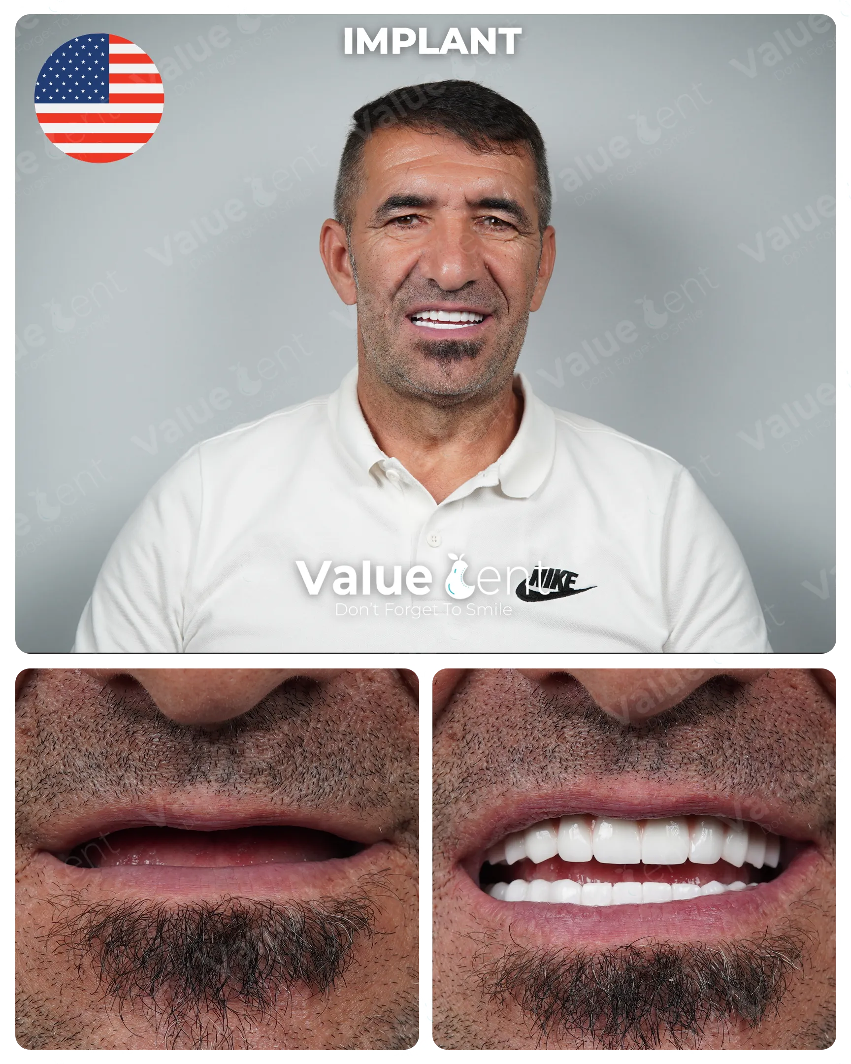 Full Mouth Implants in Istanbul Turkey at ValueDent Clinic