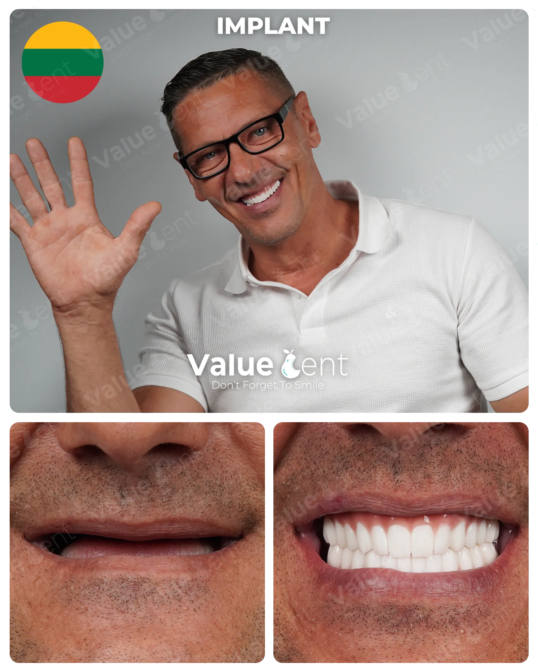 Full Mouth Implants in Istanbul Turkey at ValueDent Clinic