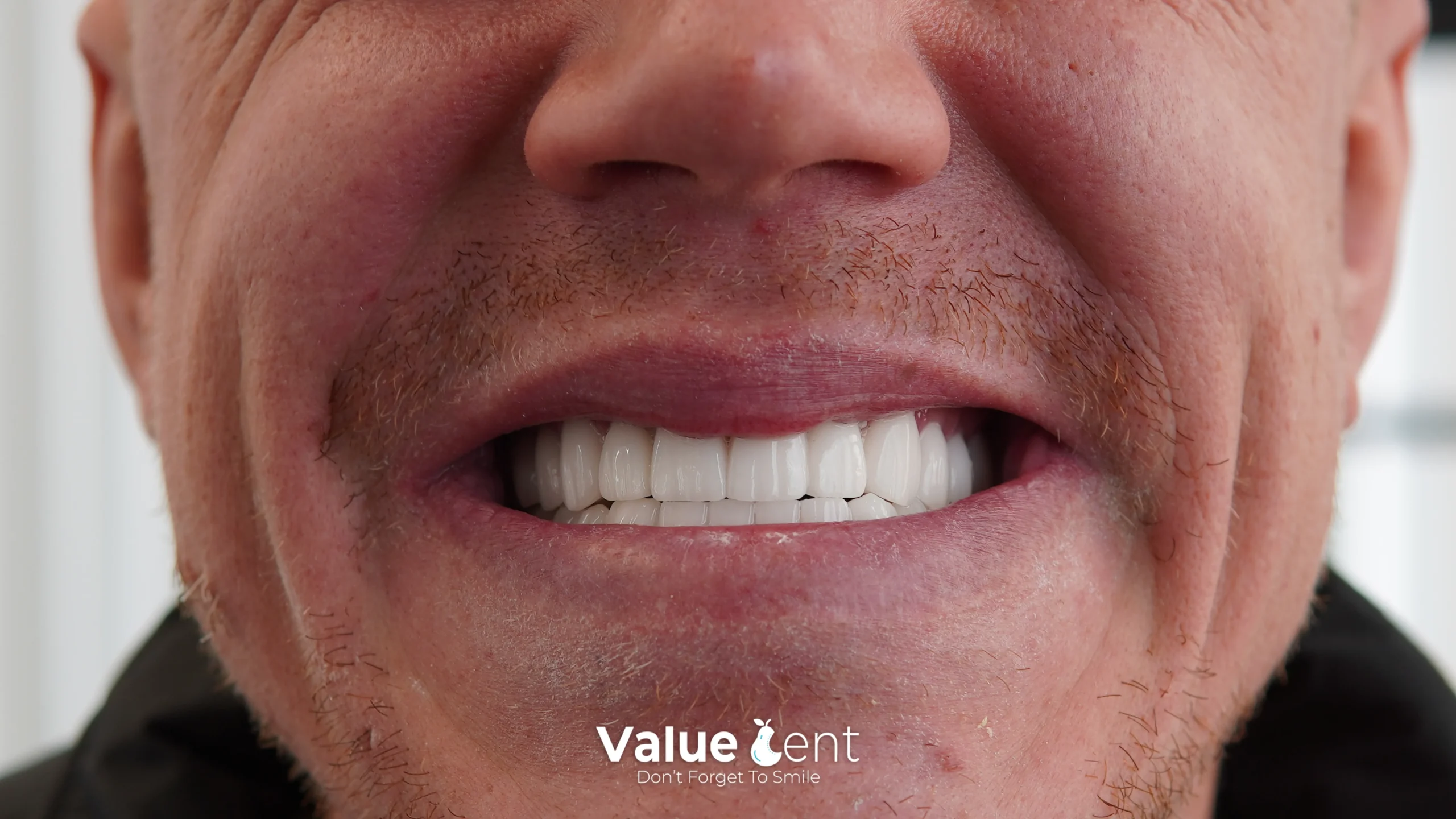 Hollywood Smile